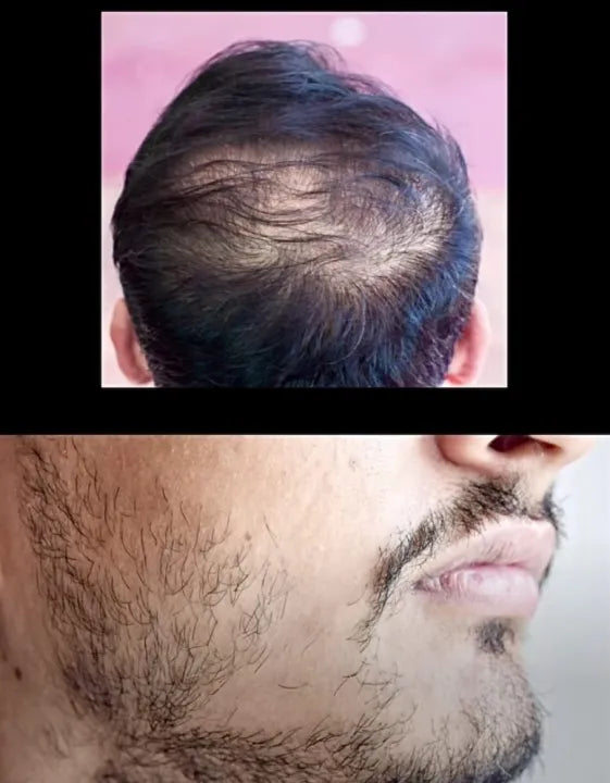 Fast Hair Growth Serum 30ml for Men & Women